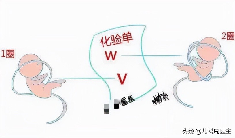 胎儿脐带绕颈怎么绕出来,胎儿脐带绕颈2圈