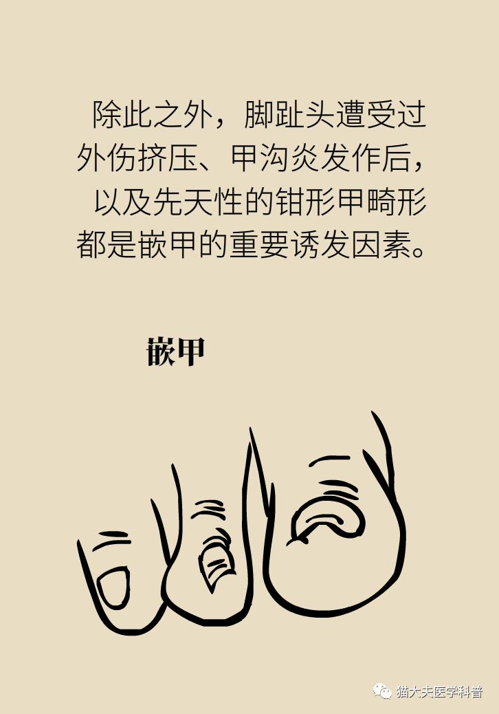 脚趾甲往肉里长怎么治除根,脚趾甲长在肉里面治疗视频