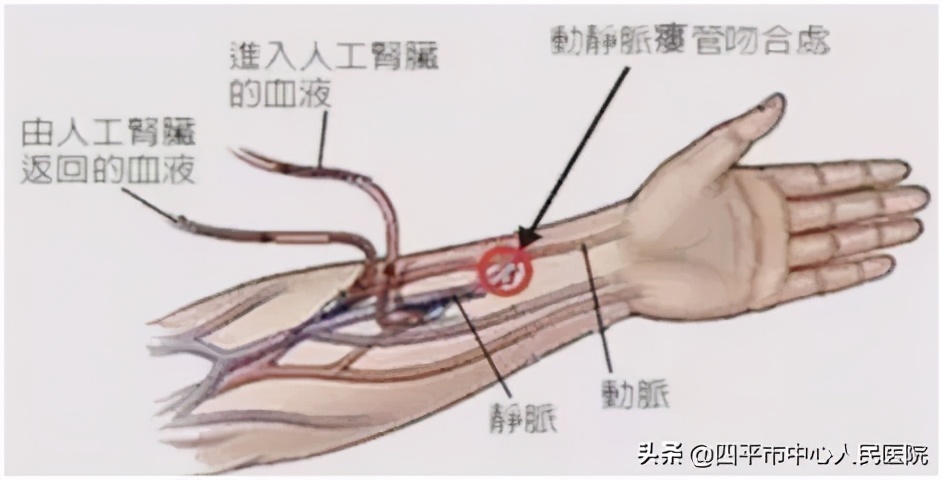 透析患者内瘘的使用和养护,透析患者内瘘护理健康宣教
