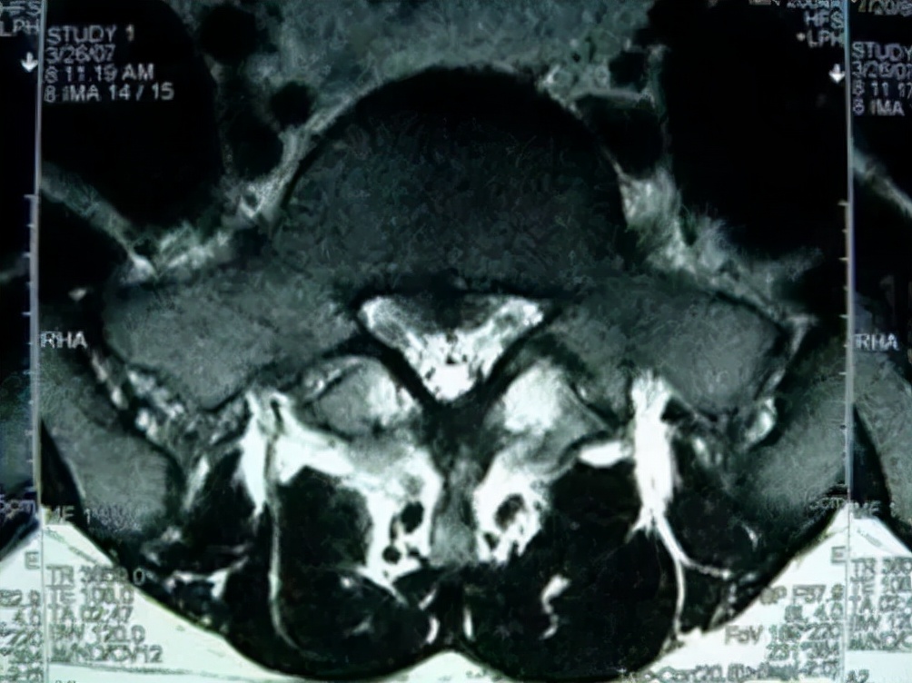 青少年一跑步就腰痛,青少年腰痛是什么原因引起的