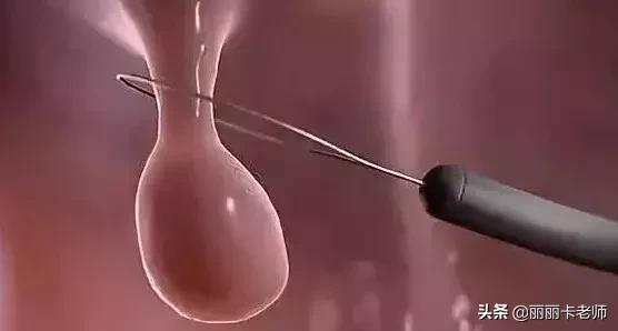 肠息肉手术后可以吃海鲜么,做完肠息肉手术后能吃鱼吗