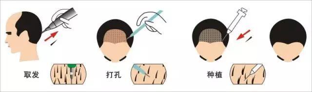 植发不会告诉你的秘密,植发真的有那么可怕吗