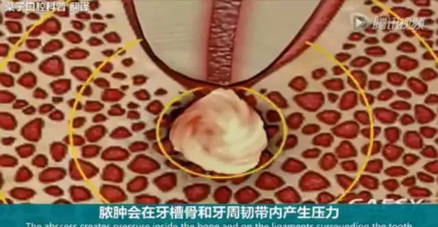 上牙龈上火突出一个鼓包,牙龈肿胀鼓包上火了吗