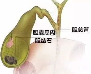 息肉是癌细胞还是痔疮,息肉是肿瘤的一种吗