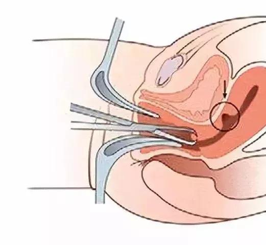 子宫切口憩室二次剖宫产,剖腹产手术十年后子宫内膜异位