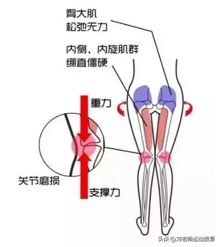 感觉腿不直？这种腿型还会导致膝盖疼，“X型”腿完整康复方案