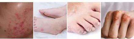 抗痘抑菌凝胶,祥顺比尔霍夫抑菌凝胶治理皮癣