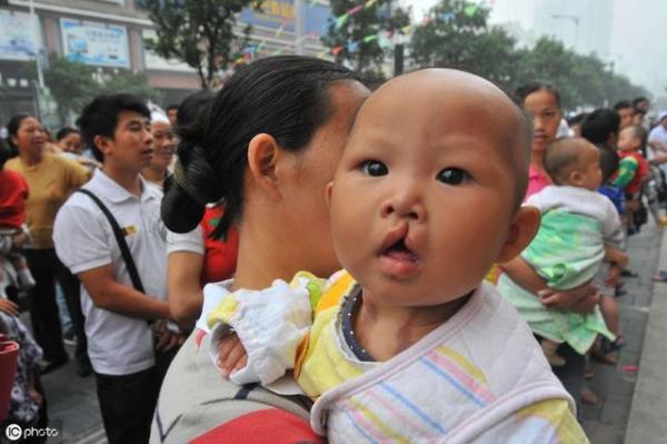 为什么会有兔唇的宝宝,宝宝为什么会长兔唇