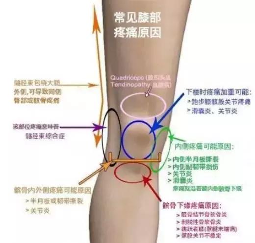 膝盖积液滑膜炎偏方,滑膜炎膝盖积液饮食要注意什么