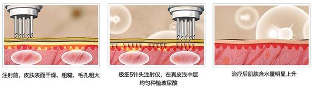 玻尿酸的效果,玻尿酸的美容优势有哪些