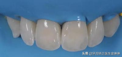 淄博的水氟斑牙,内蒙古氟斑牙是怎样形成的