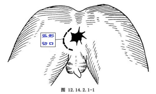 肛瘘lift手术的优缺点,lift手术治疗肛瘘后多久会复发