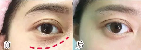 脂肪粒怎么用针挑出的,脂肪粒多久可以用针挑出来