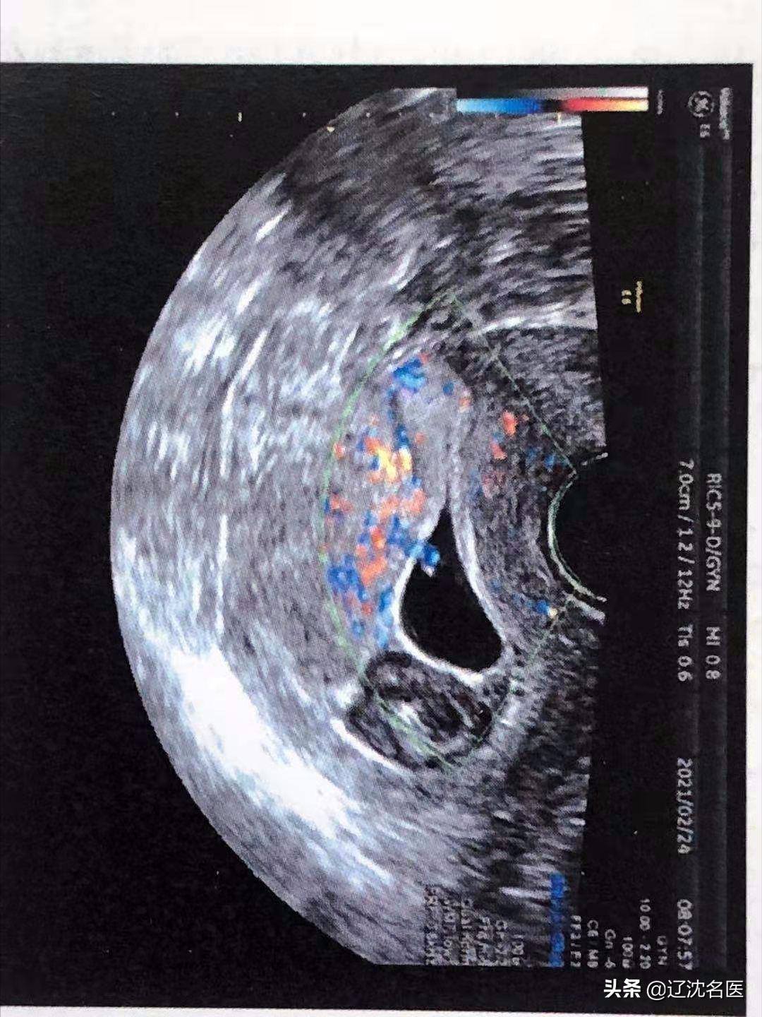 怕疼的话还是选择剖腹产,剖腹产4种疼痛方法