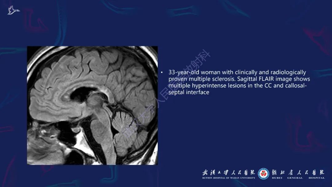 胼胝体肿瘤影像鉴别,胼胝体病变影像诊断