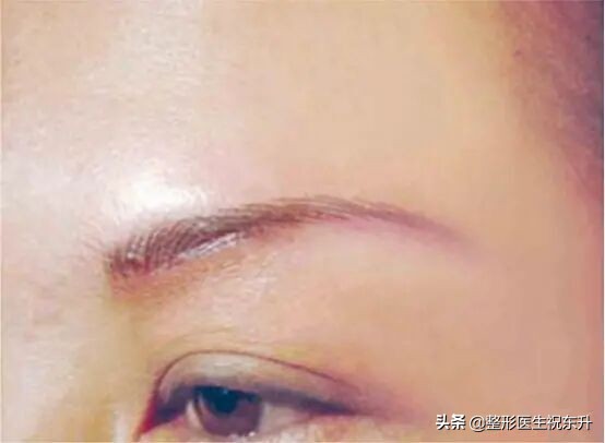 提眉术的优点及缺点,提眉术怎么才算做得好