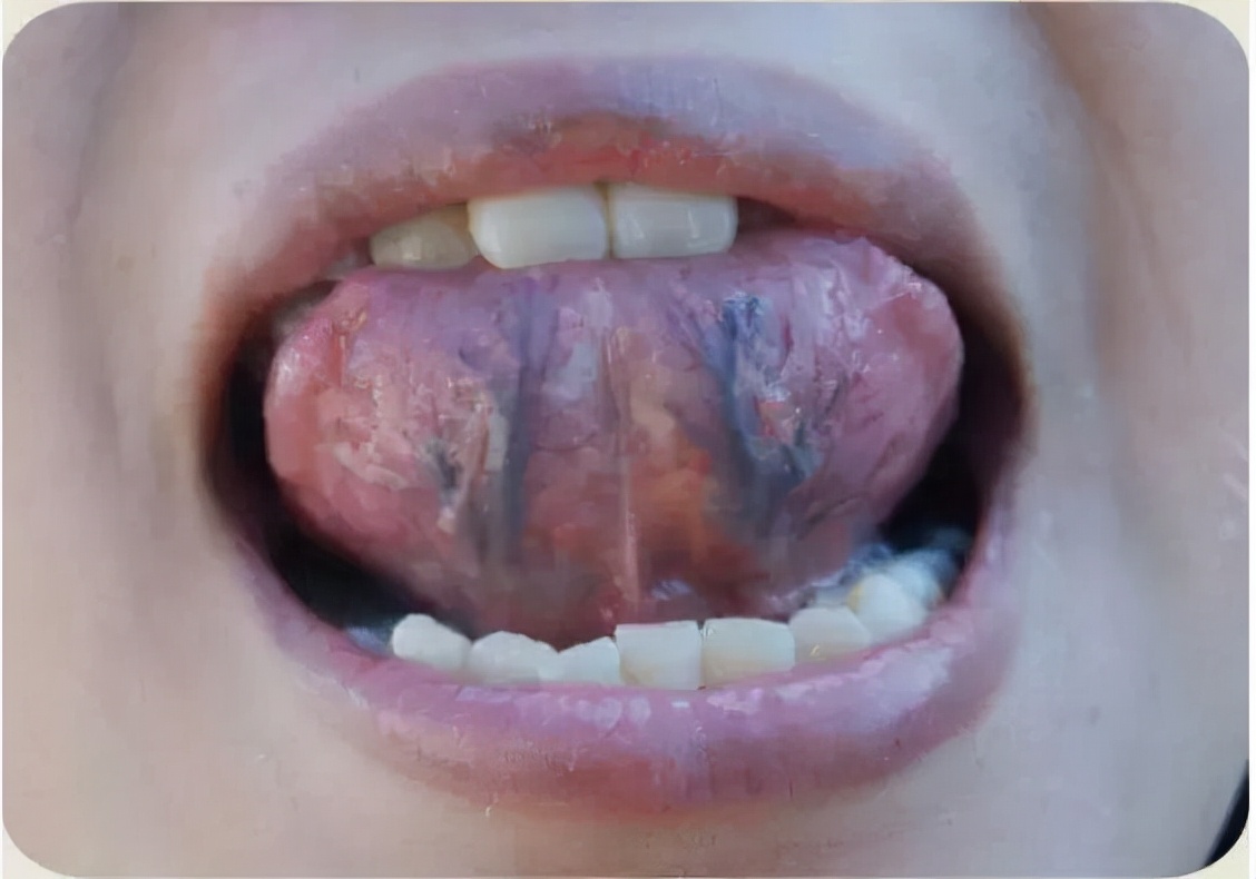 气虚血瘀证和血瘀体质是一回事,血瘀是什么样的图片