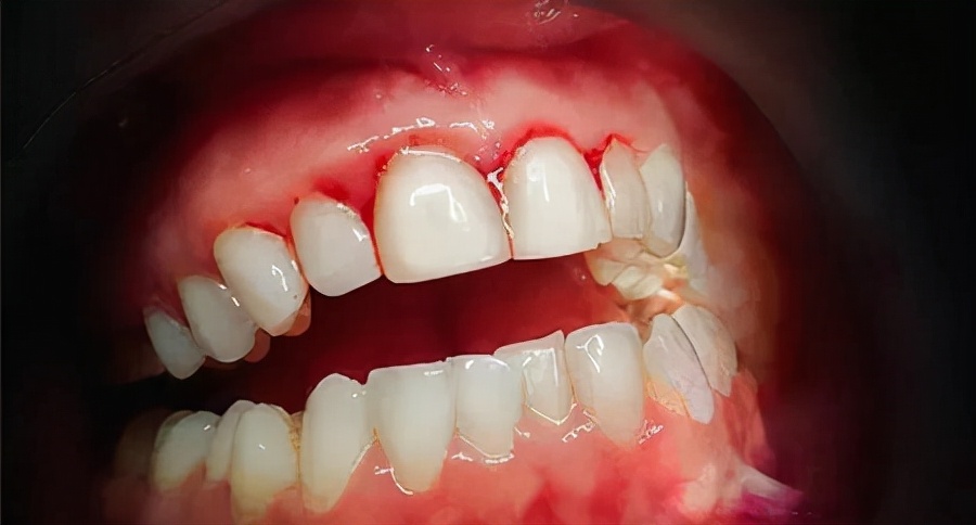 种一颗牙上万,种植牙换牙齿价格