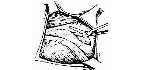 正常的子宫能不能切,子宫动过刀子还能怀孕吗