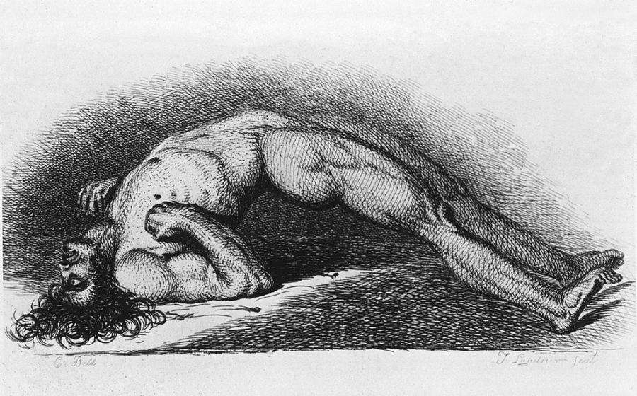 打完破伤风抗毒素后会得破伤风吗,破伤风抗毒素能预防破伤风吗