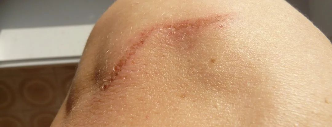 切菜不小心被刀口划了,手在切菜时被划伤了应该怎么办