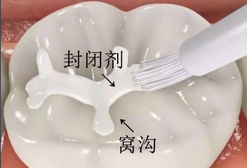 孩子龋齿要不要治疗,孩子龋齿要拔牙还是治疗