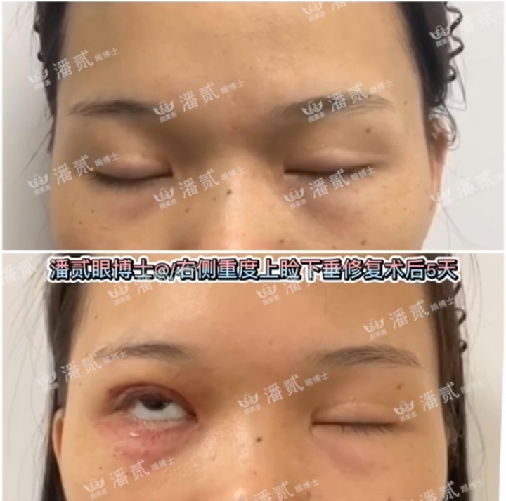 重度上睑下垂术后为什么闭不上眼睛？闭眼不全怎么护理好？