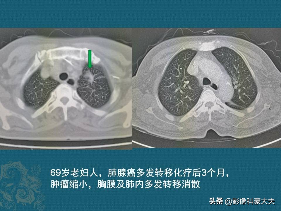 肺癌晚期的肿瘤有多大,肺癌晚期患者肿瘤一般是多大