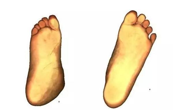 儿童左右腿骨骼发育不一致,2岁男童走路好像腿软总是摔倒