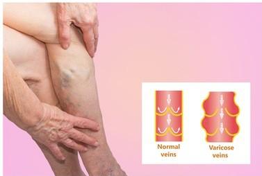 腿疼血栓是什么原因引起的,腿疼可能是血栓的征兆