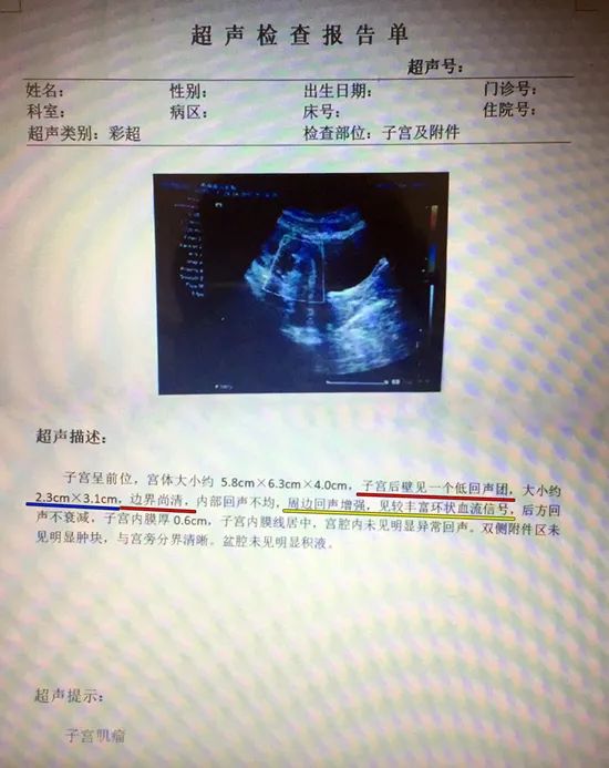 如何读懂“B超报告单”上的子宫肌瘤
