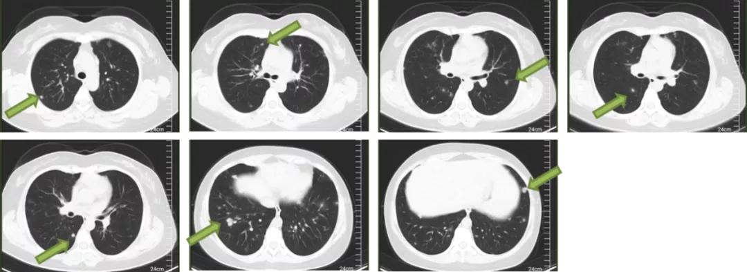 双肺多发结节，反复检查为何诊断重点成「盲区」？