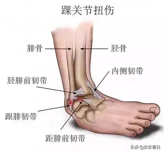 崴脚后遗症的三步恢复法,很多人的脚都崴伤