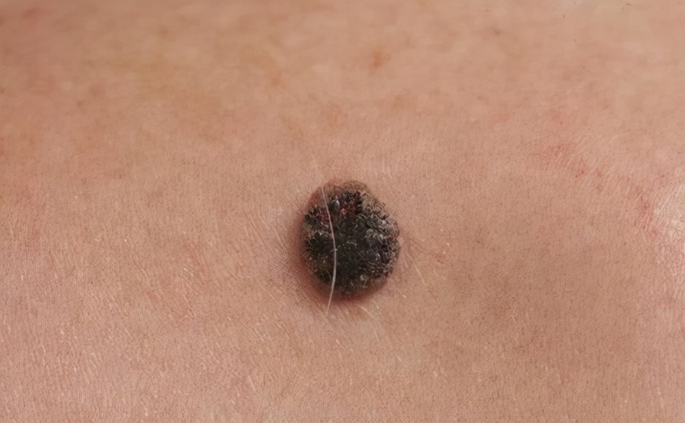 皮肤上突然出现一个小肉球,皮肤长了个凸起的小肉球怎么回事