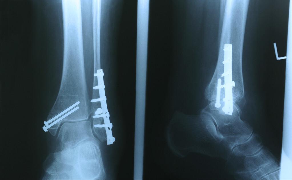 骨折固定的注意事项,骨折后需要注意哪里