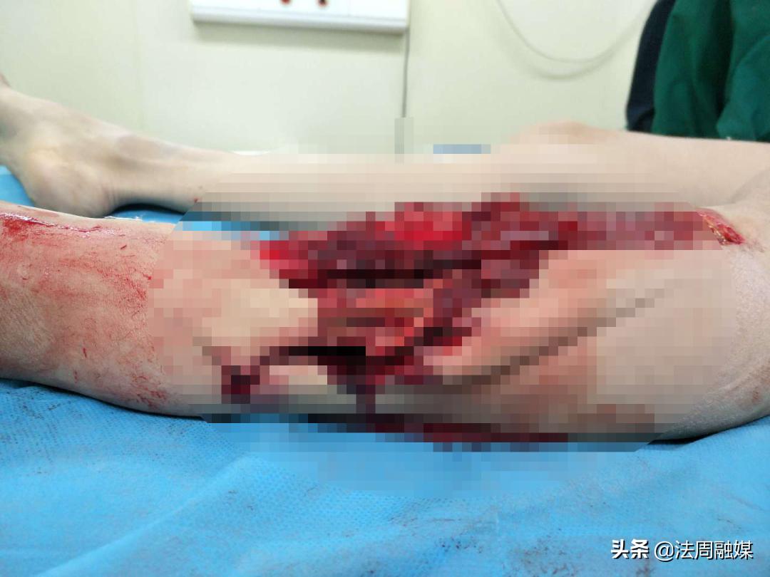 交通事故小腿胫骨骨折做手术,常德市第一中医医院骨伤科