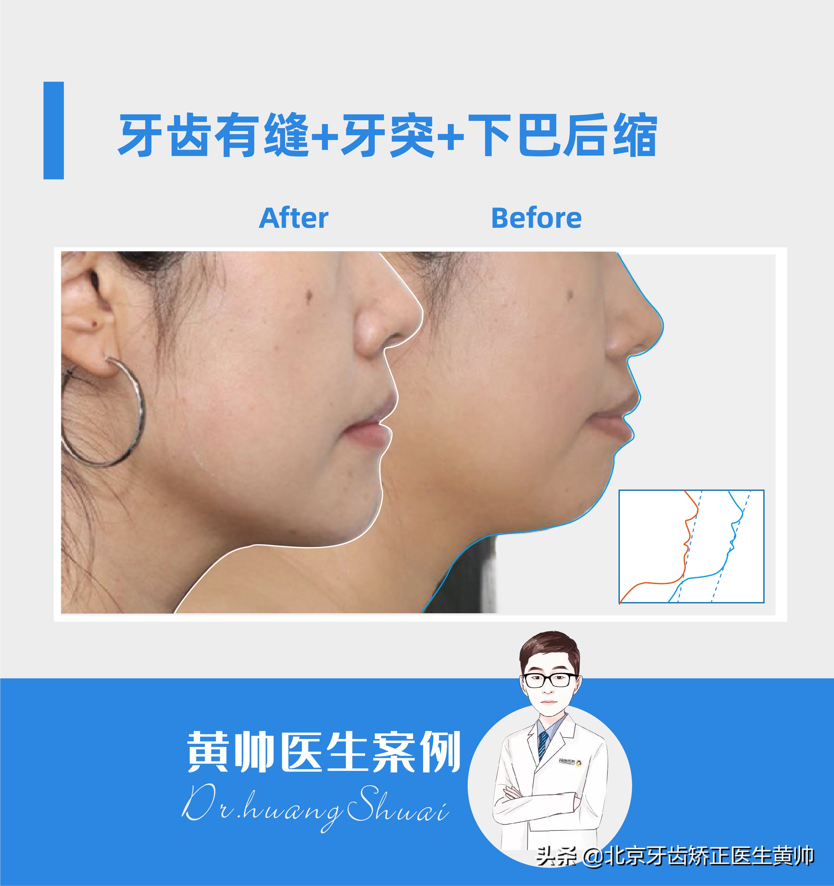 橡胶牙套矫正后脸型变化,戴过牙套的脸恢复了吗