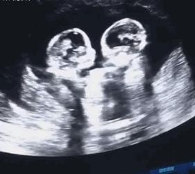 双胞胎在子宫里的发育,双胞胎在子宫里是不是两个包