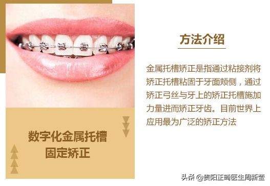 变美干货分享轻医美,矫正牙齿小干货