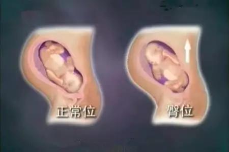 孕期臀位顺产,孕期臀位怎么纠正视频