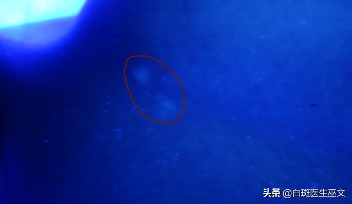 突发性白癜风治好了还会复发吗,白癜风好了一个月了没有症状