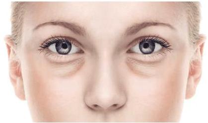 激光祛眼袋适合哪类人,生姜祛眼袋的正确方法