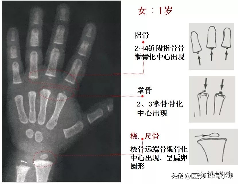 骨龄片对照图谱测骨龄准不,骨龄14岁男孩骨龄图谱