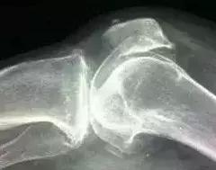 白术治骨刺的方法,脚底骨刺怎么治最快方法