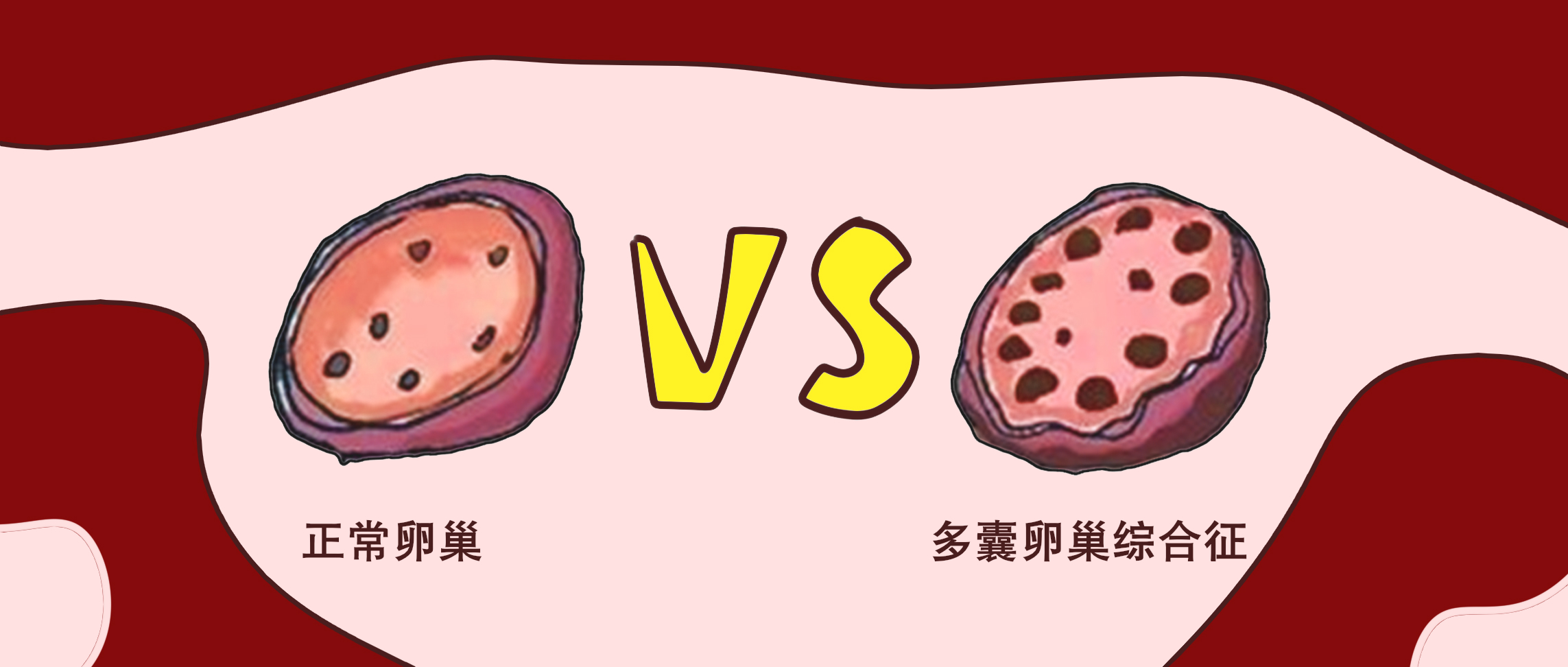 多囊多毛长痘怎么消除,多囊卵巢肥胖皮肤差怎么办