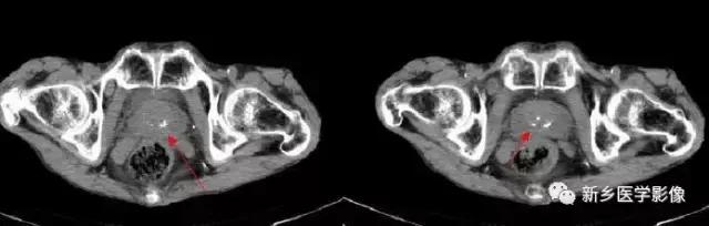 腹部平片能看到结石吗,腹部高密度结节影是什么