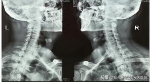 李氏砭法刮痧直播,李氏虎符铜砭刮痧治腰椎间盘突出