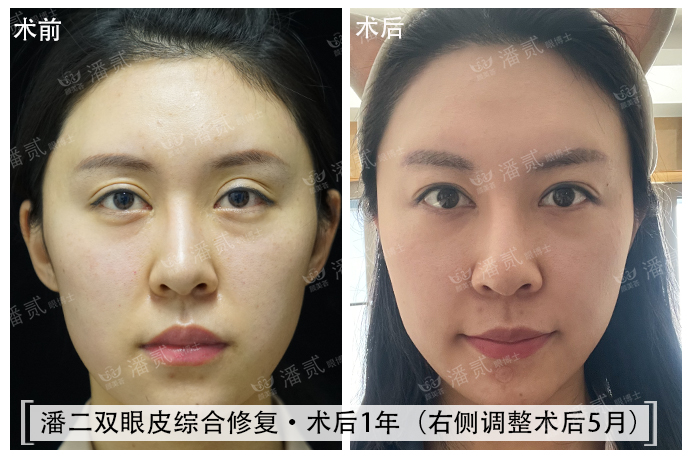 双眼皮失败的女孩,双眼皮失败做成了三眼皮好修复吗