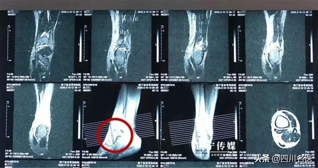不小心崴脚了是啥征兆,男子不小心崴到脚了