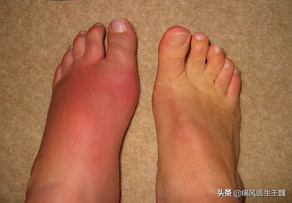 为什么痛风那么难消肿,痛风到底有多可怕这篇文章说透了